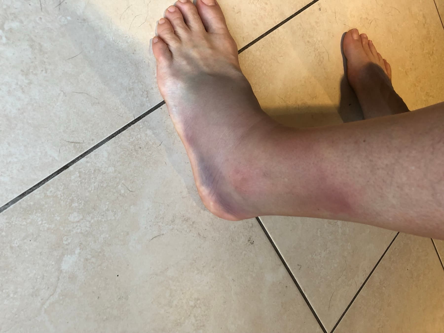 Badly bruised and swollen sprained ankle two weeks before race day